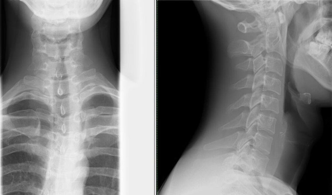 Омыртқаның рентгені остеохондрозды диагностикалаудың қарапайым және тиімді әдісі болып табылады
